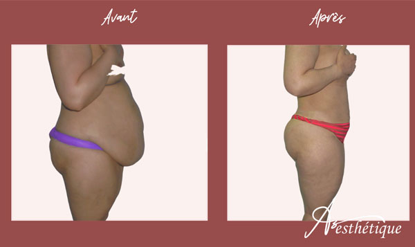 plastie abdominale et abdominoplastie avant apres azesthetique